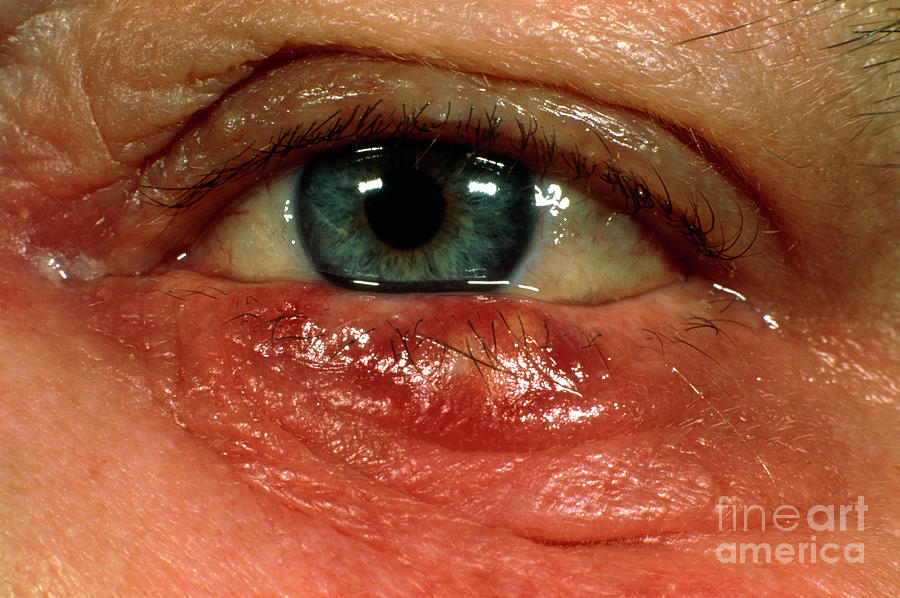 Stye (hordeolum) On Patient's Lower Eyelid Photograph by Dr. Chris Hale ...