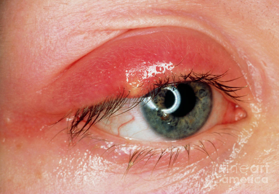 stye-on-upper-eyelid-photograph-by-western-ophthalmic-hospital-science