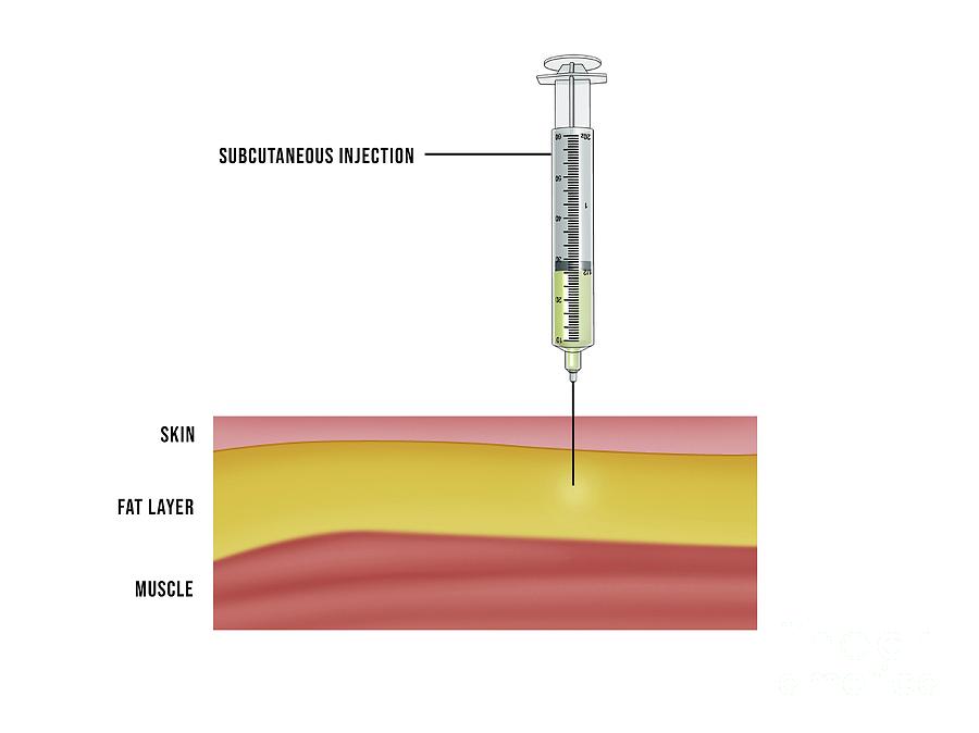 Subcutaneous Injection by Maurizio De Angelis/science Photo Library