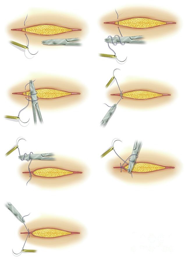 Suturing Of Surgical Incision Photograph By Maurizio De Angelis Science 