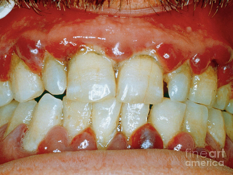 Swollen Inflamed Gums In Scurvy Photograph By Biophoto Associates