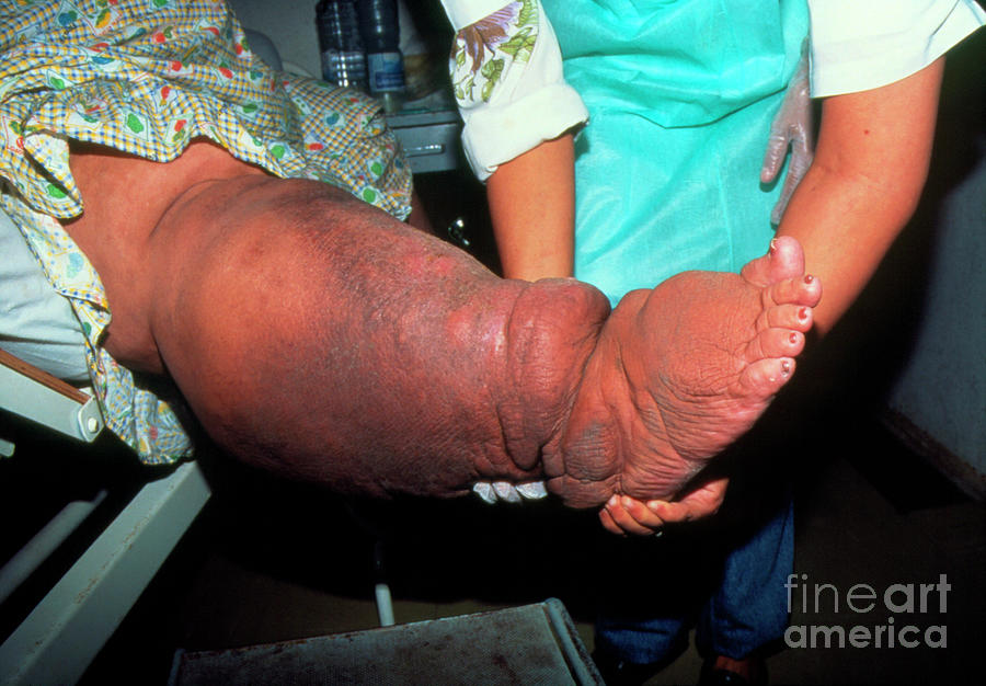 Swollen Leg Of Elephantiasis Patient Photograph by Andy Crump, Tdr, Who/science Photo Library