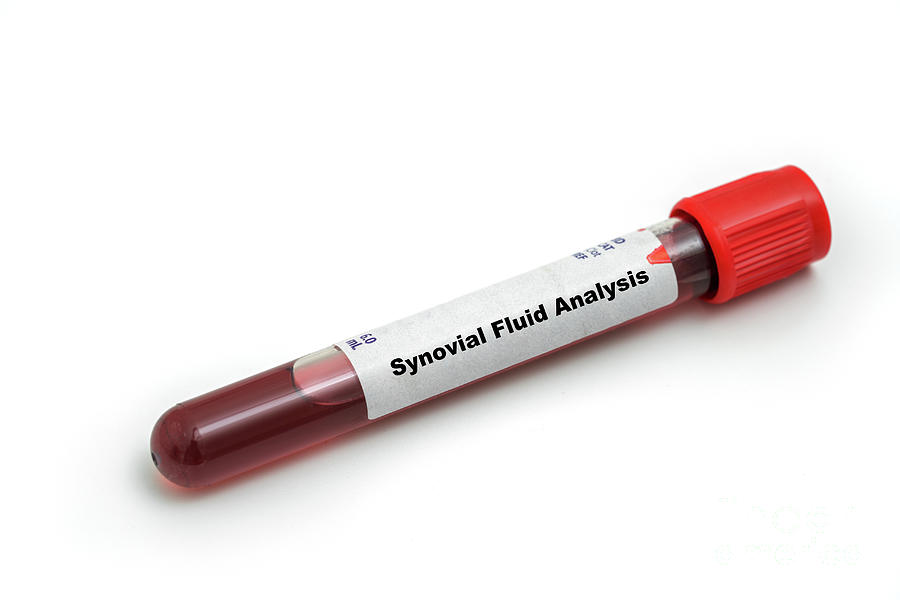 Synovial Fluid Analysis Photograph by Science Photo Library Synovial Fluid Analysis Photograph by Science Photo Library