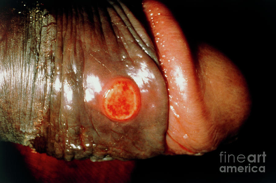 Syphilis Chancre On Penis Photograph by Biophoto Associates/science Photo Library