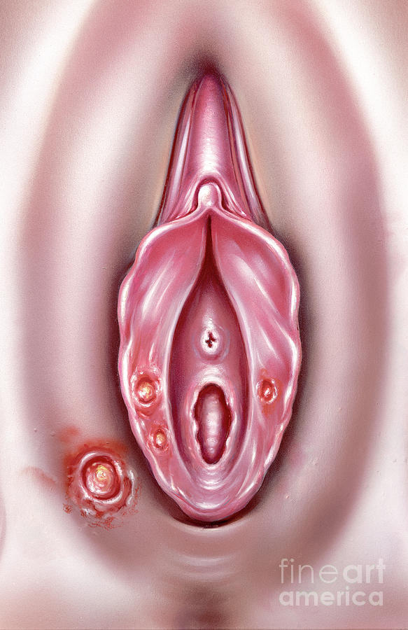Syphilis Chancres On Vulva Photograph by John Bavosi/science Photo Library