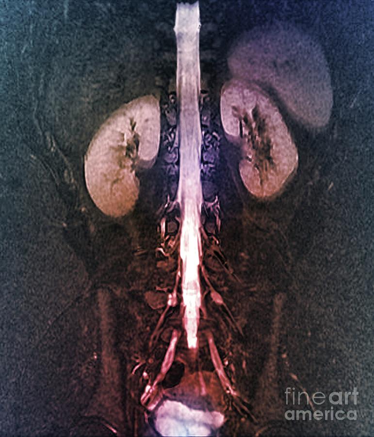 Tarlov Spinal Cysts Photograph by Zephyr/science Photo Library - Pixels