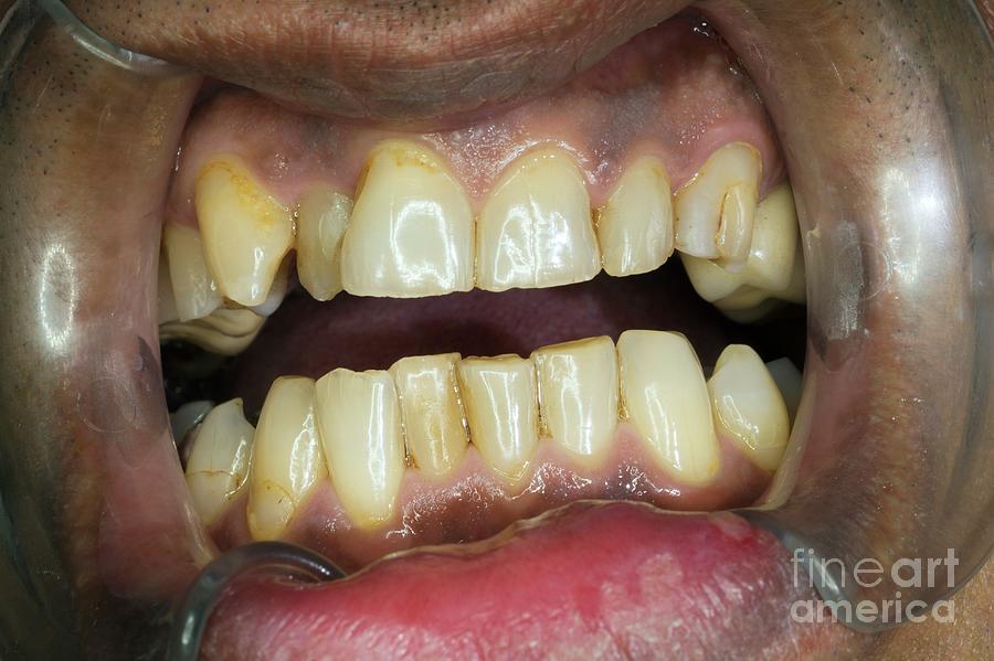 Teeth Before Whitening Photograph By Dr Armen Taranyanscience Photo