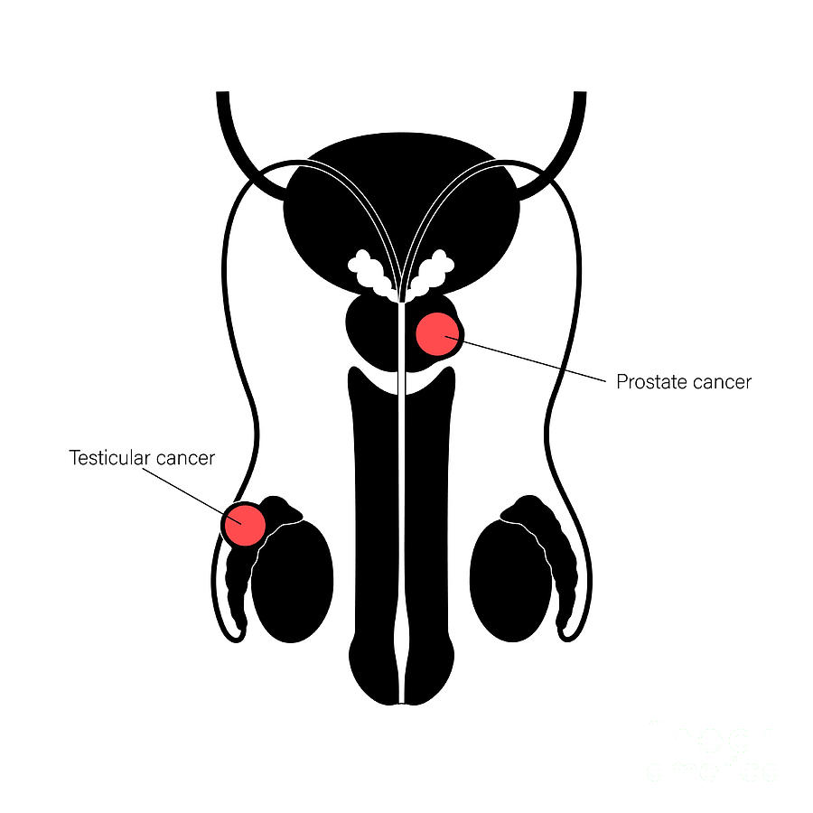 Testicular And Prostate Cancer Photograph By Pikovit / Science Photo ...