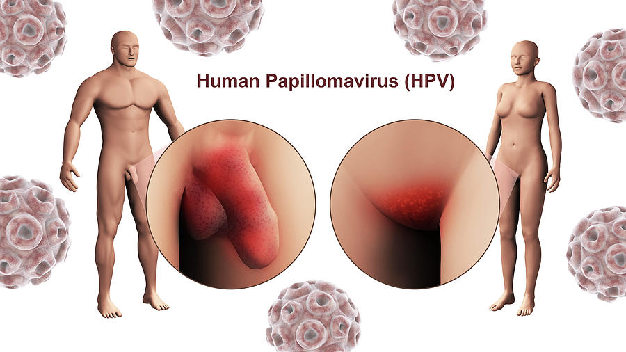 The Human Papillomavirus Infection Hpv Photograph by Stocktrek Images