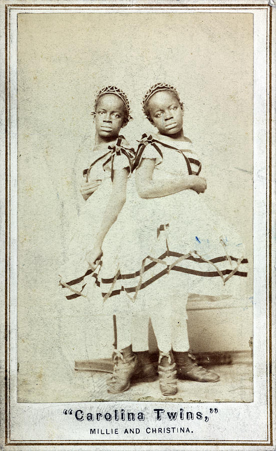 The Mccoys, American Conjoined Twins Photograph by Science Source