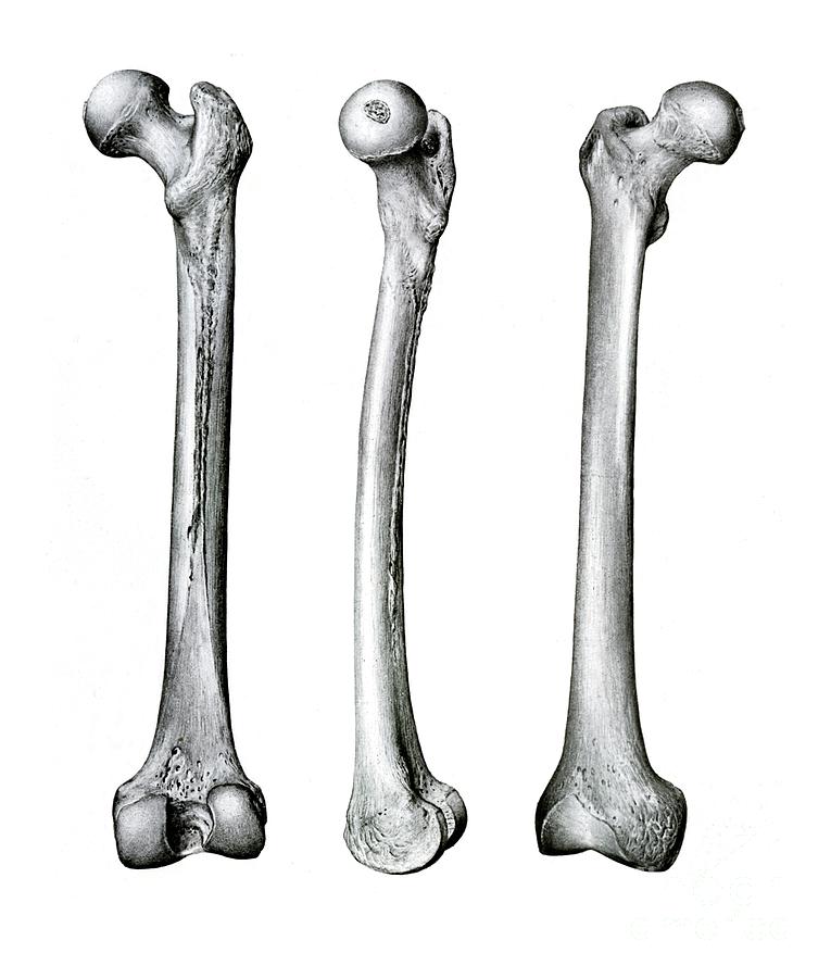 Thigh Bone Photograph By Microscape science Photo Library Pixels