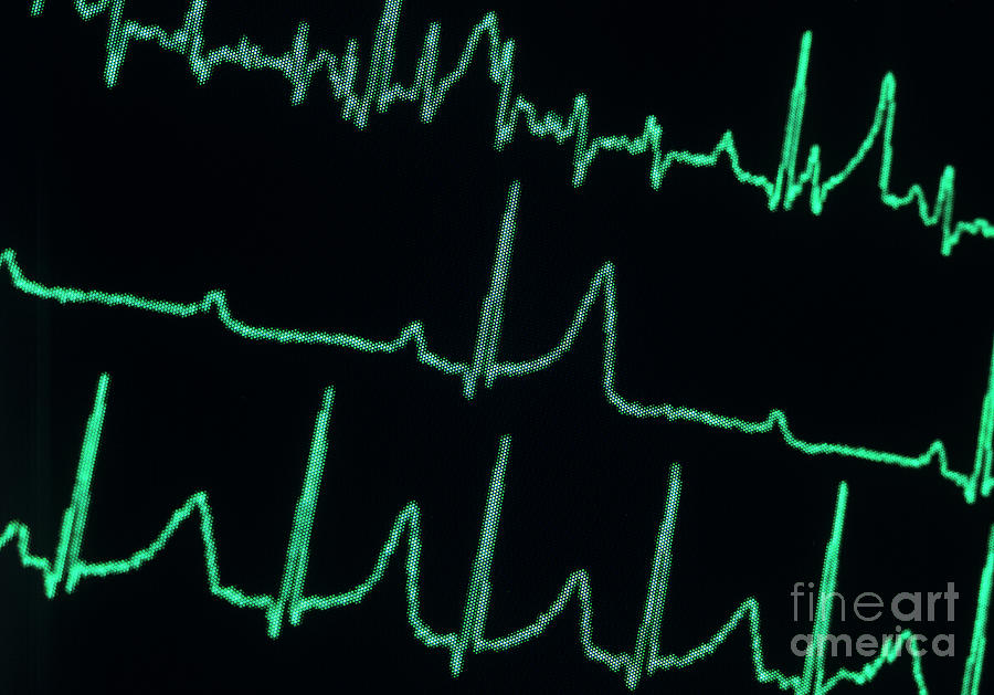 Third Degree Heart Block Animation