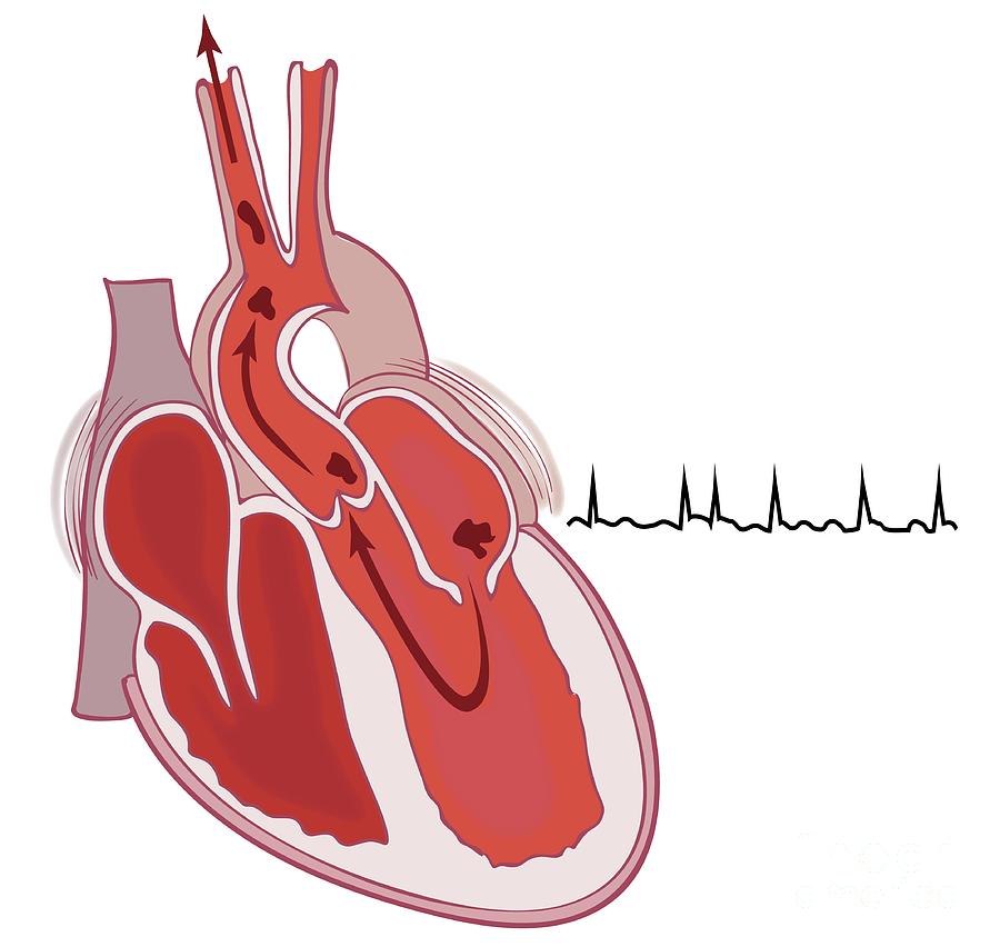 Thrombosis Caused By Atrial Fibrillation Photograph by Jeanette ...