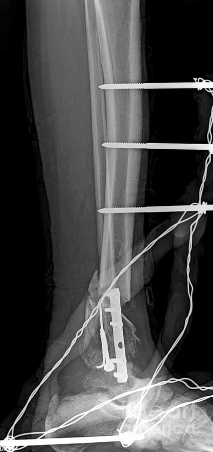 Tibial Fracture Photograph by Rajaaisya/science Photo Library
