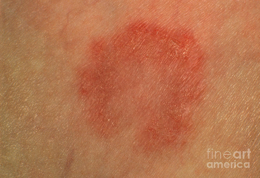 Tinea Corporis Ringworm Lesion On Skin Photograph By Dr Chris Hale My