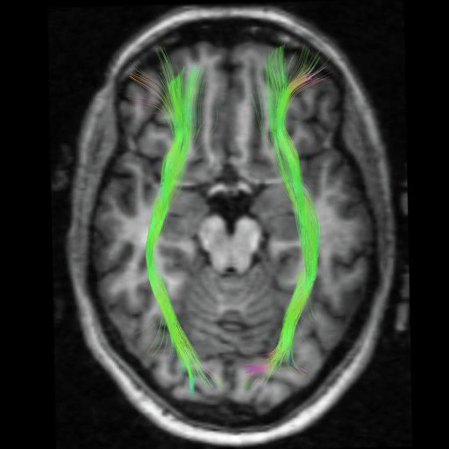 Top View Of The Fronto-occipittal Connections, Connecting Frontal And ...