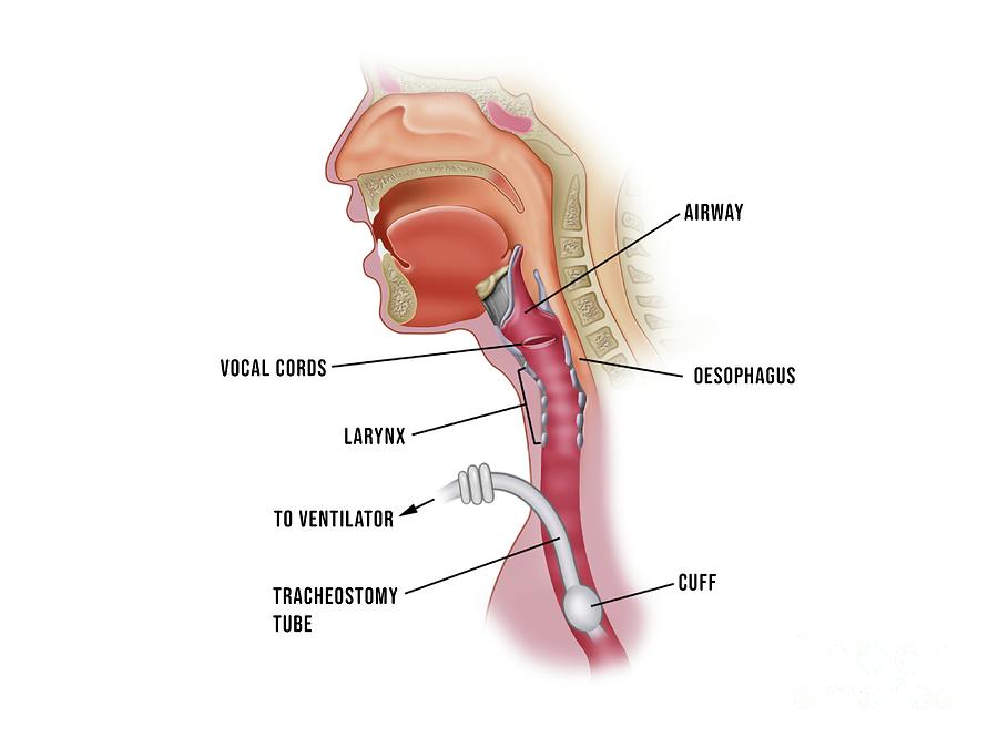 tracheostomy procedure anatomy