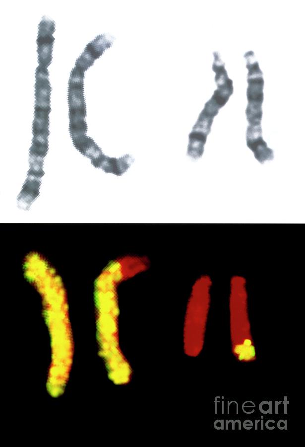 Translocation Of Chromosomes 5 And 14 Photograph By Dept Of Clinical Cytogenetics Addenbrookes 