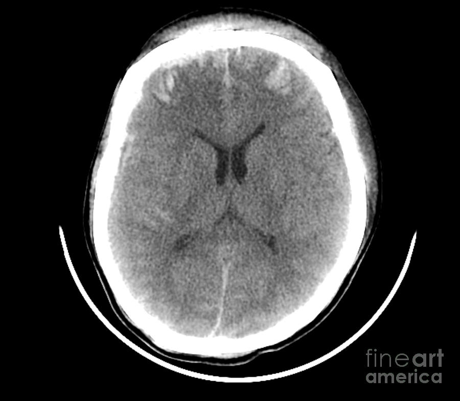 Traumatic Brain Injuries by Rajaaisya/science Photo Library