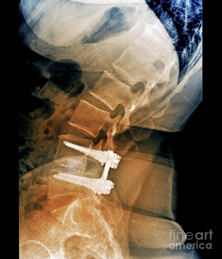 Treatment Of Spinal Disc Herniation Photograph By Zephyrscience Photo Library 8926