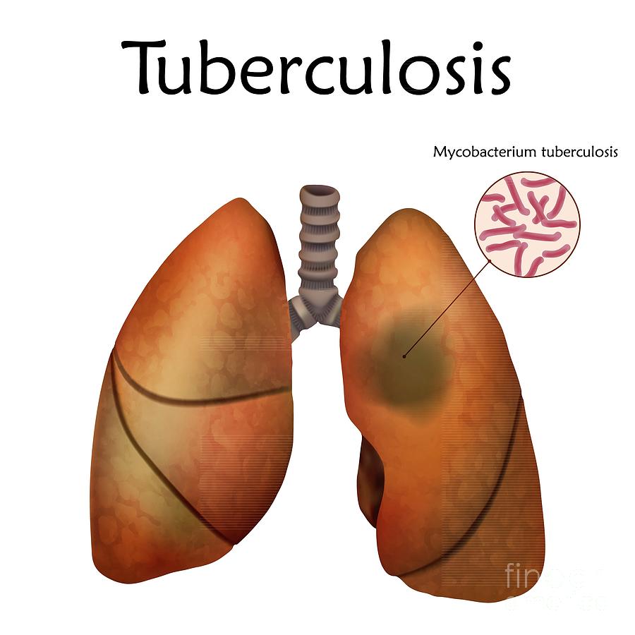 Tuberculosis Photograph by Veronika Zakharova/science Photo Library