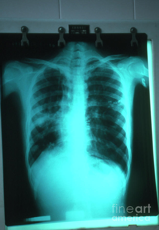 Tuberculosis X-ray Photograph by A. Crump, Tdr, Who/science Photo ...