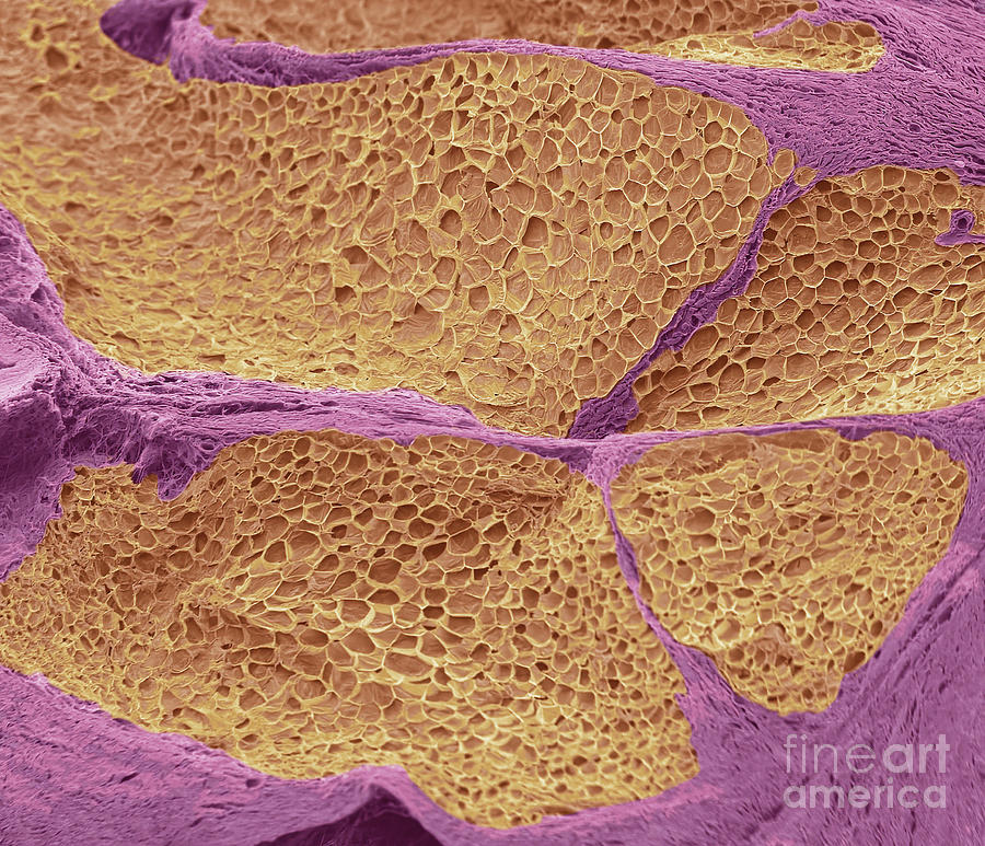 Tumour Adipose Tissue Photograph by Steve Gschmeissner/science Photo Library