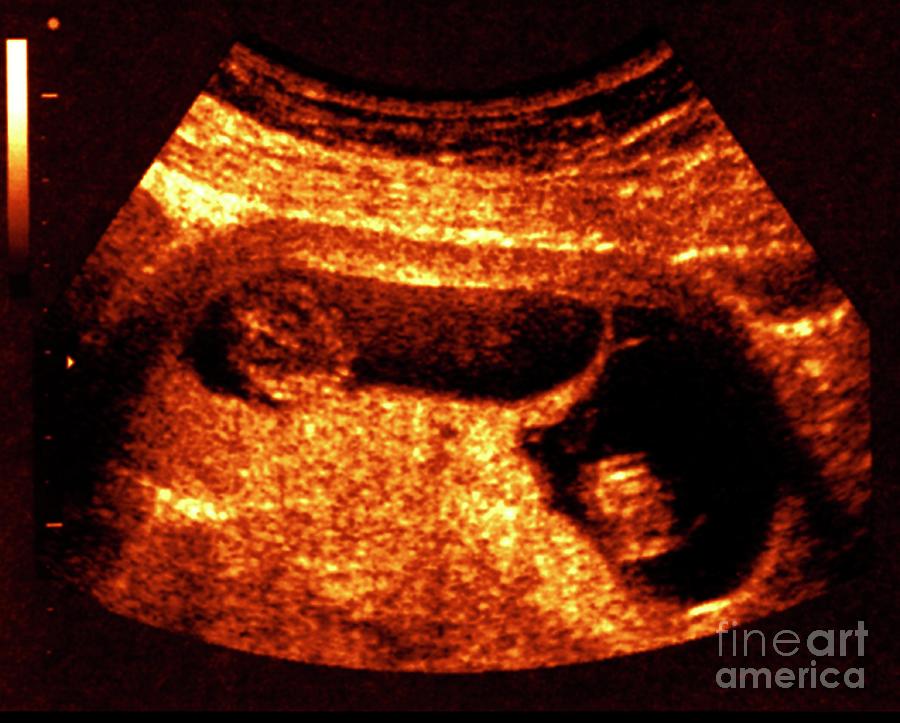 Twin Foetuses At 9 Weeks Photograph by Zephyr/science Photo Library