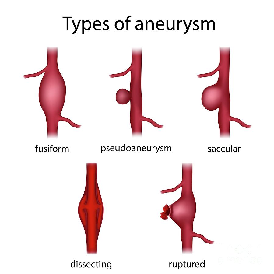 types-of-aneurysm-photograph-by-veronika-zakharova-science-photo-library