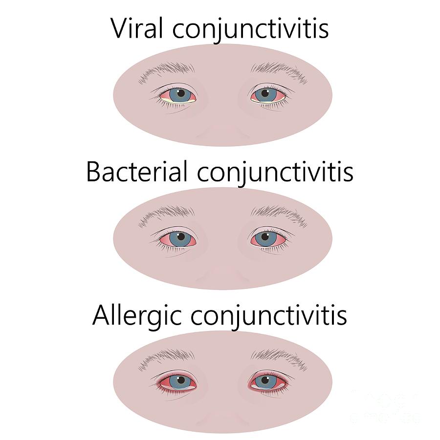 Types Of Conjunctivitis Photograph By Veronika Zakharovascience Photo Library