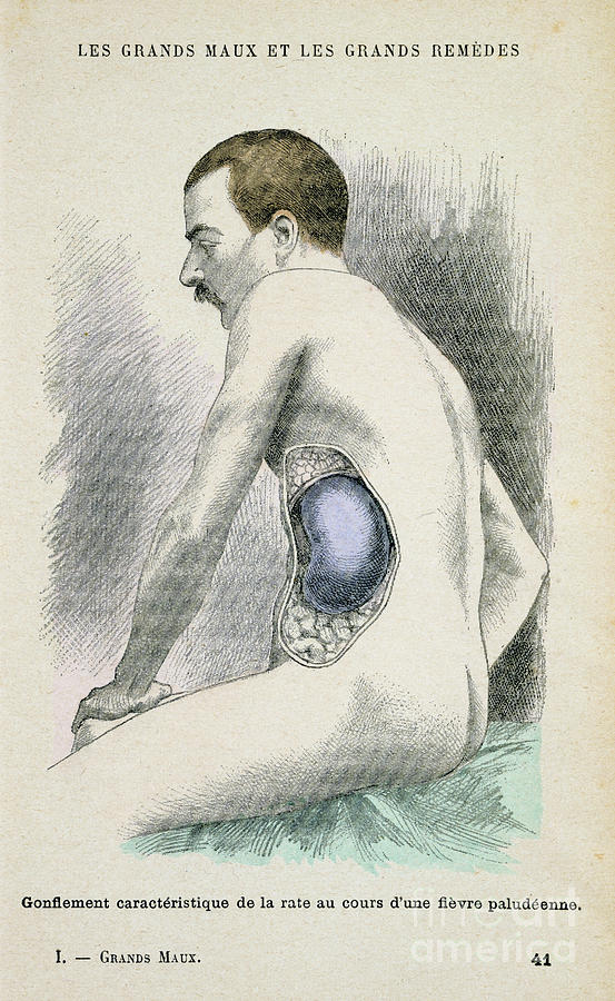 Typical Enlarged Spleen Of A Malaria Drawing by Print Collector