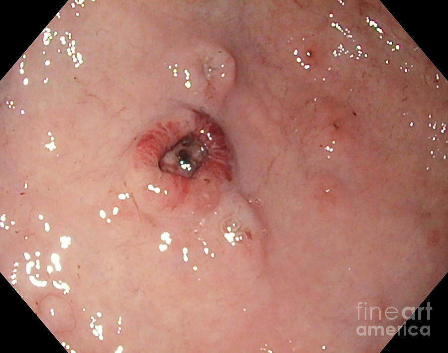 Disease Photograph - Ulceration In Gastric Lymphoma by Gastrolab/science Photo Library