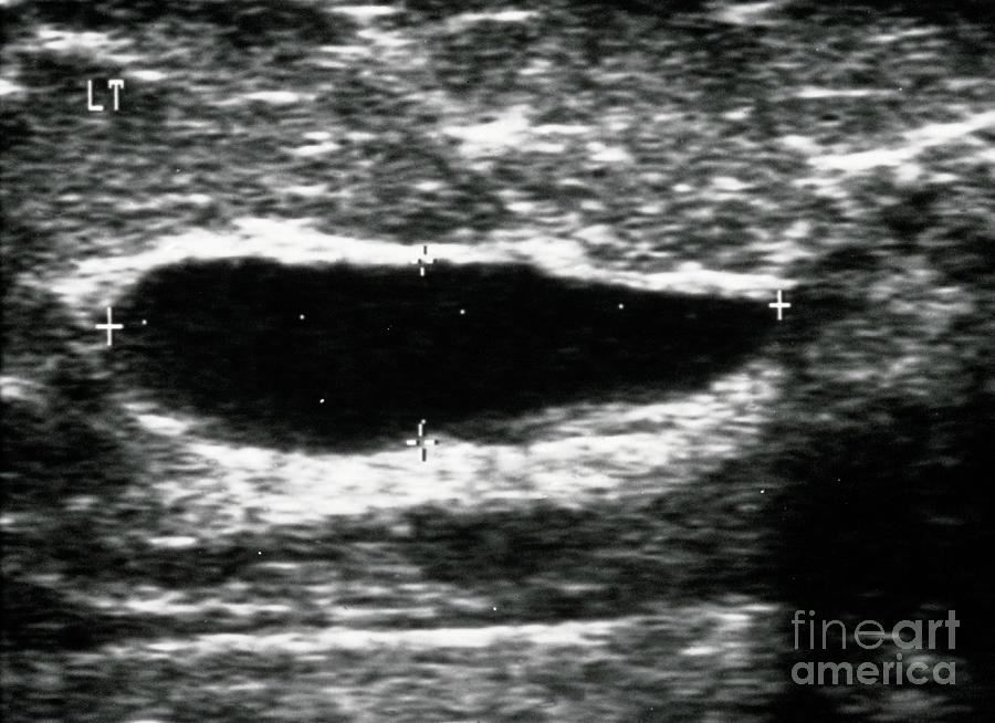 Ultrasound Image Of A Female Breast Showing A Cyst Photograph By Breast