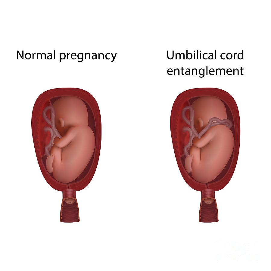 cord presentation in pregnancy