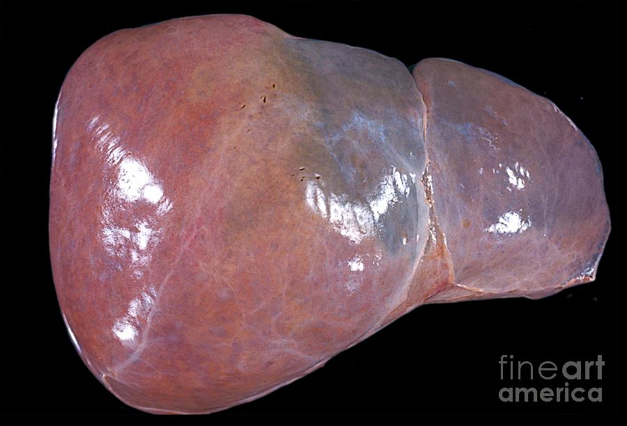 Unhealthy Human Liver Photograph by Jose Calvo / Science Photo Library