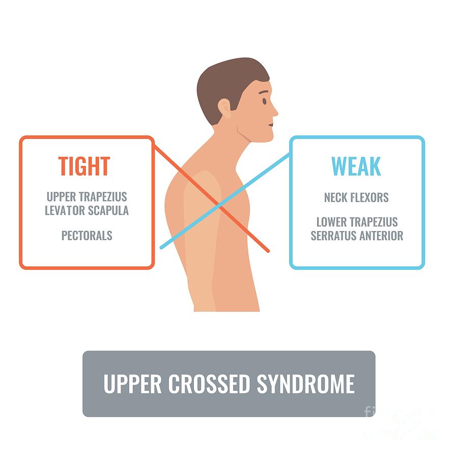 Upper Crossed Syndrome Photograph by Art4stock/science Photo Library ...