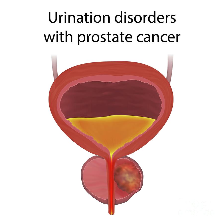 Urinary Disorders With Prostate Cancer Photograph by Veronika Zakharova ...