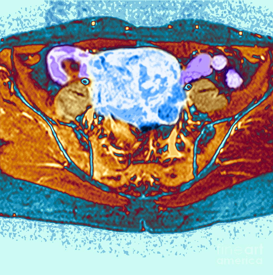 Uterine Fibroid Photograph by Simon Fraser/newcastle Royal Nhs Trust ...