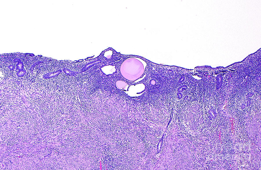 Uterus Endometrium With Atrophy Photograph by Ziad M. El-zaatari ...