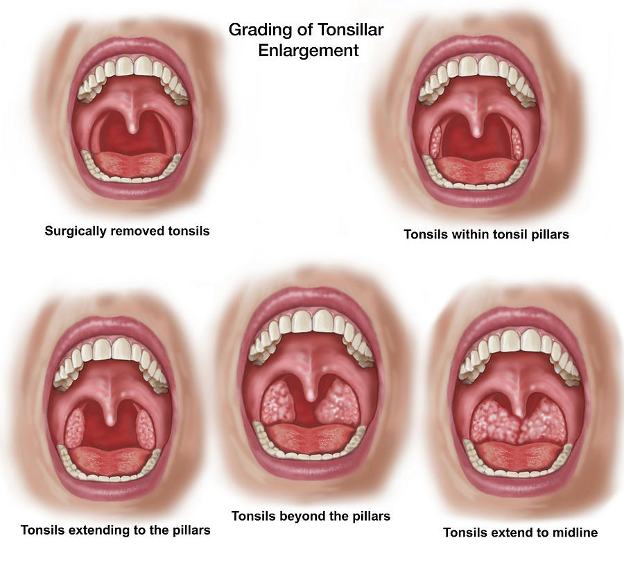 Various Stages Of Tonsillar Photograph By Elise Walmsley Mac Wha Pixels