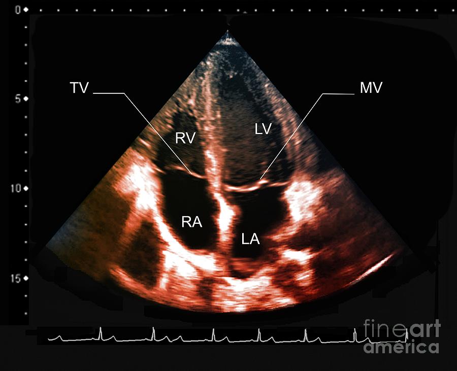 Ventricular Enlargement Photograph by Zephyr/science Photo Library