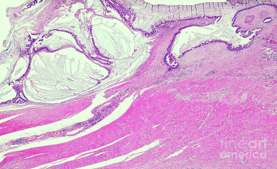 Villous Colon Adenocarcinoma Photograph By Nigel Downer Science Photo