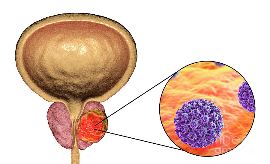 Viral Etiology Of Prostate Cancer Photograph by Kateryna Kon/science ...