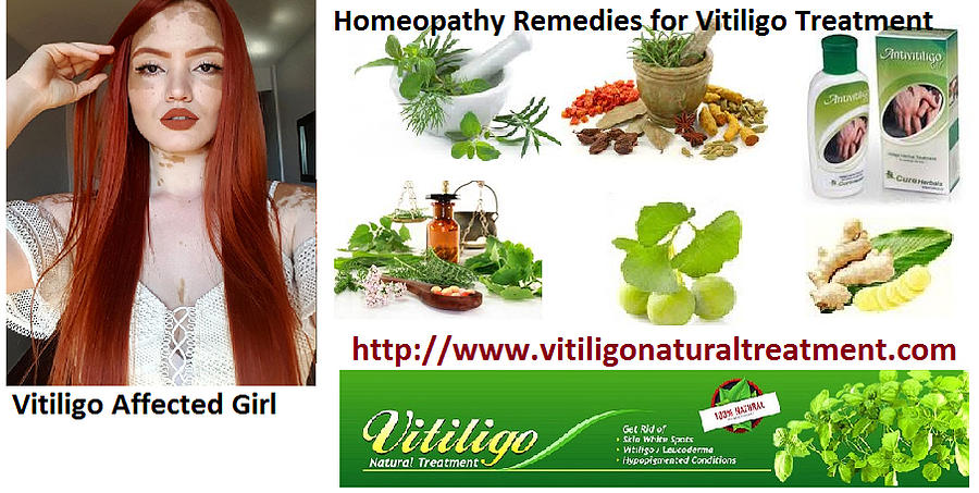 Vitiligo and its Natural Treatment with Homeopathy Method Photograph by  Freya Iris - Fine Art America