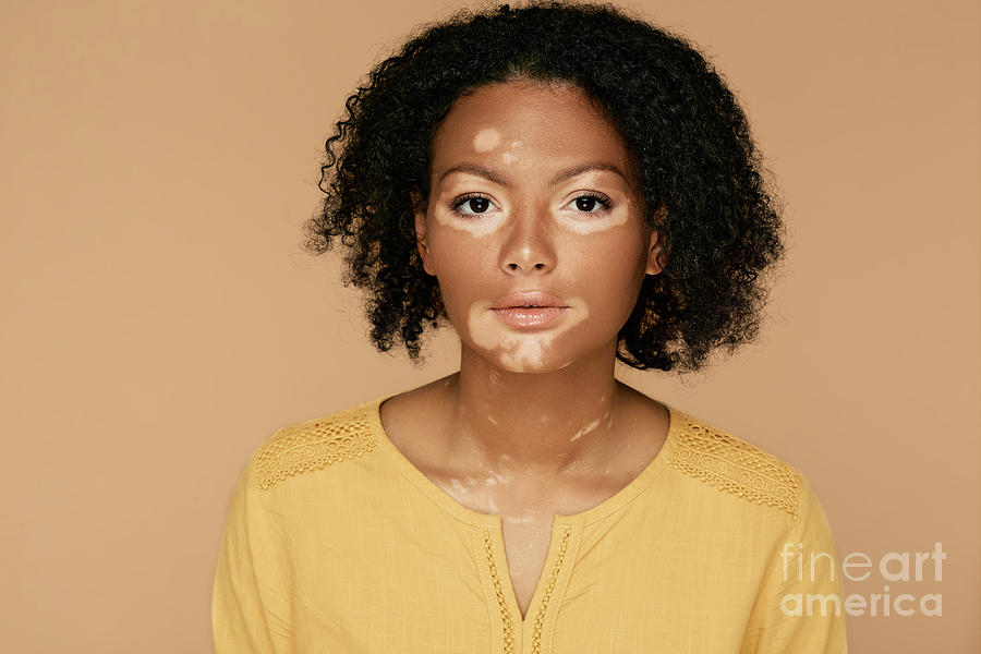 Vitiligo Photograph by Peakstock / Science Photo Library | Pixels