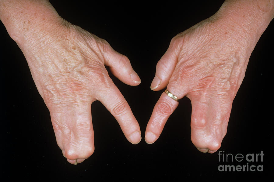 Webbed Fingers Photograph by St Bartholomew Hospital/science Photo Library