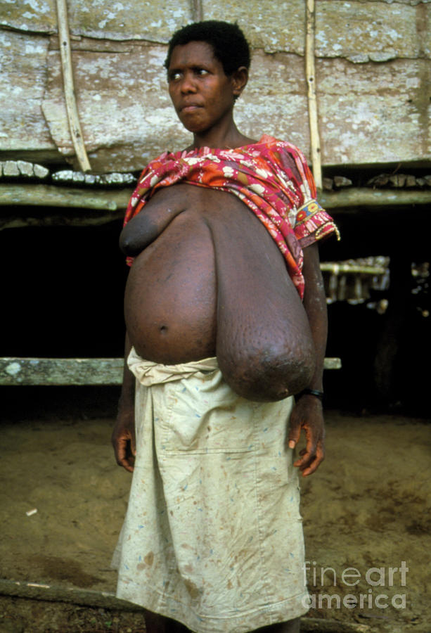Woman With A Breast Enlarged By Elephantiasis Photograph by A. Crump, Tdr, Who/science Photo Library