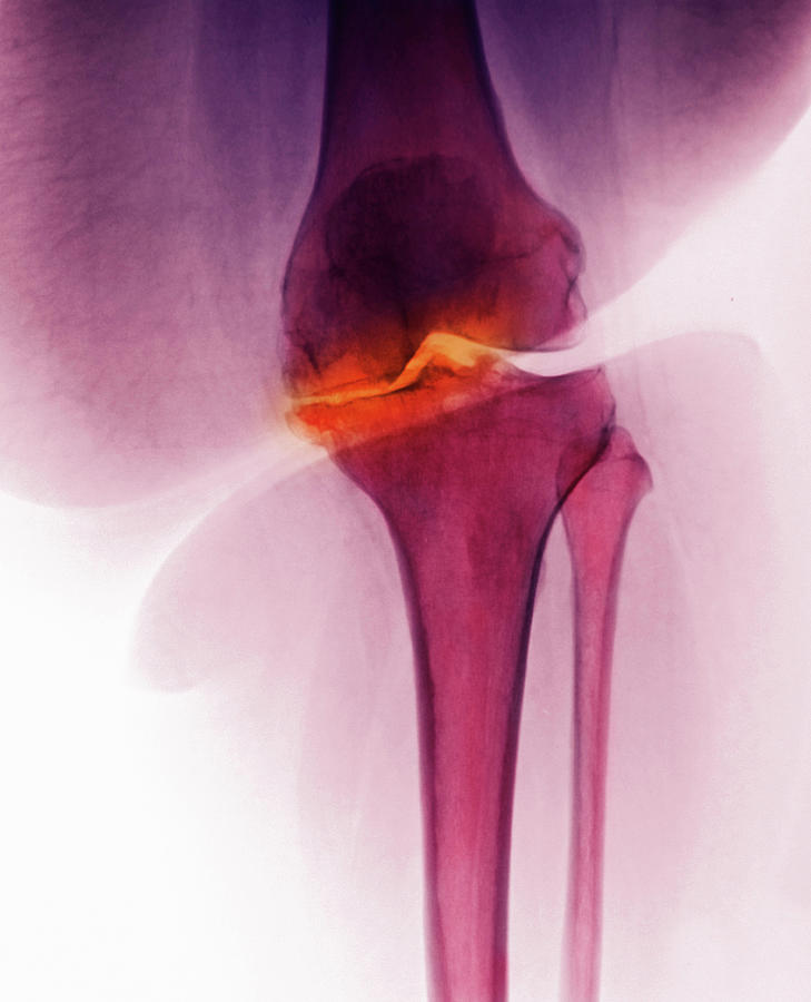 X-ray Of Knee Showing Degenerative Arthritis Digital Art by Callista ...
