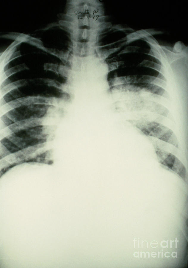 X-ray Of Lungs In Pulmonary Oedema Photograph by Science Photo Library ...