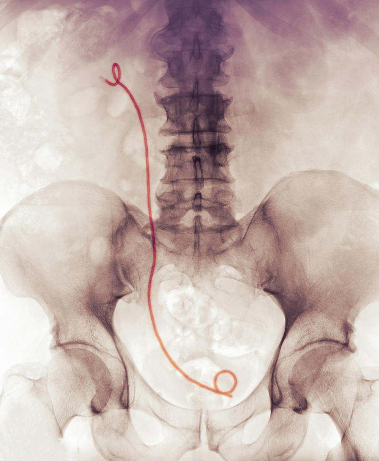 x-ray-showing-a-ureteral-stent-digital-art-by-callista-images-fine